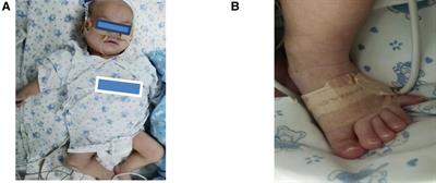 Case report: A preterm infant with rubinstein-taybi syndrome and Marmorata telangiectatica harboring a frameshift mutation in the CREBBP gene